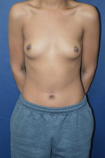 Before-5-1-1-1285x2048