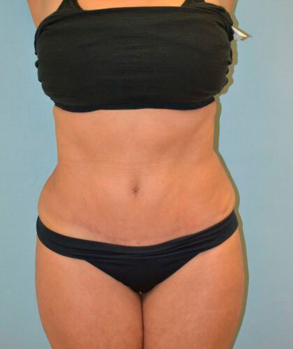 before_after_md-42138-1745966-after-1647368248494e1-420x632-1