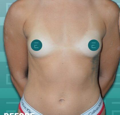 breast1-copy-420x469