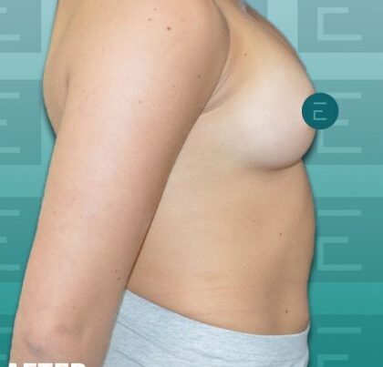 breast2-420x475
