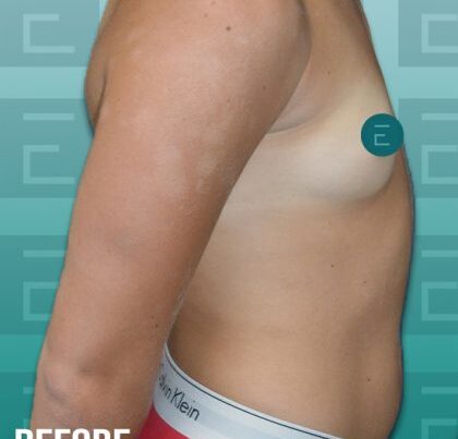 breast2-copy-420x463