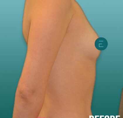 breast3-copy-1-420x463