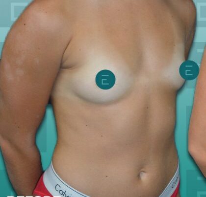 breast3-copy-420x481