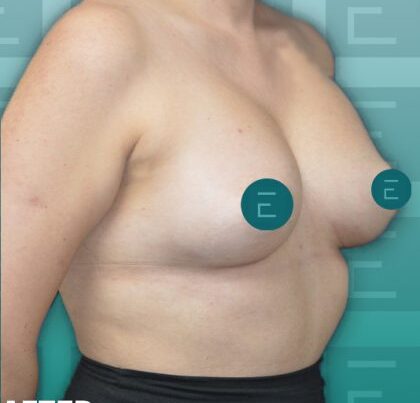 breastaug2-420x478