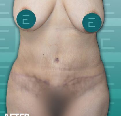 esth2-420x464-1