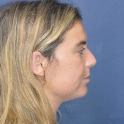 After-5-13-21-27-YO-Female-Liposuction-to-chin-8-664x1024