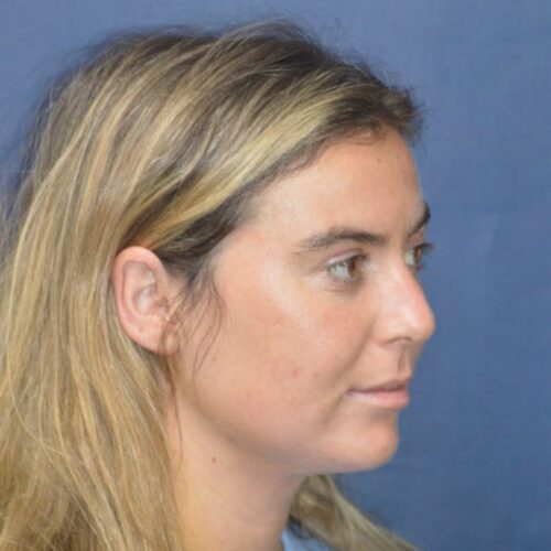 After-5-13-21-27-YO-Female-Liposuction-to-chin-9-701x1024