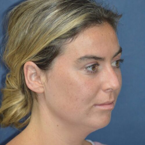 Before-5-6-21-27-YO-Female-Liposuction-to-chin-15-680x1024