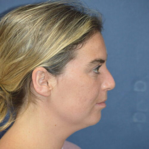 Before-5-6-21-27-YO-Female-Liposuction-to-chin-17-681x1024
