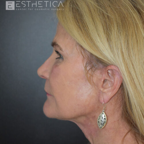 Lower-facelift-1-after-3