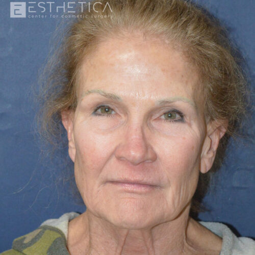 Lower-facelift-1-before-1
