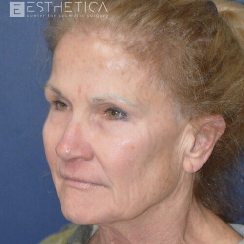 Lower-facelift-1-before-2