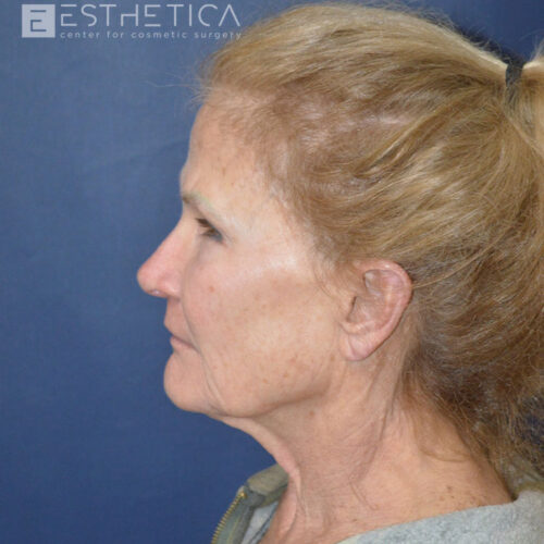 Lower-facelift-1-before-3