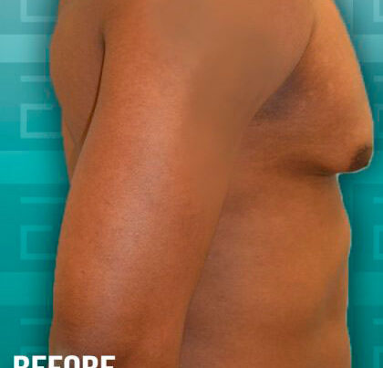 gyn-420x458-before