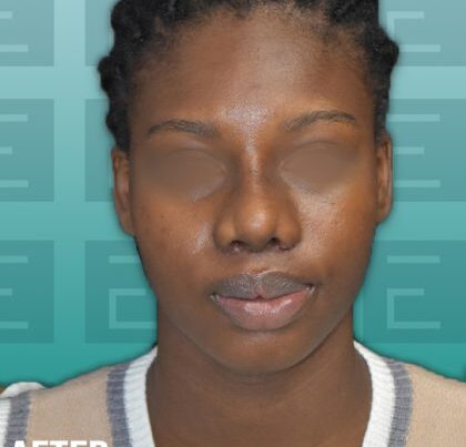 nose1-420x470