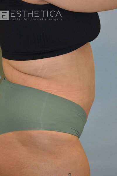 27yo__FemaleLiposuction-of-the-abdomen,-flanks,-and-abdominoplasty-with-muscle-plication__after-1