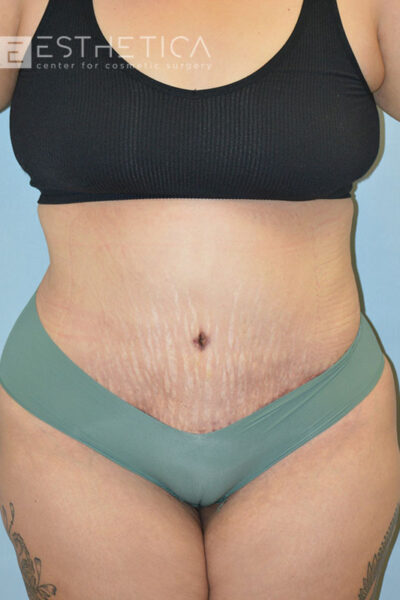 27yo__FemaleLiposuction-of-the-abdomen,-flanks,-and-abdominoplasty-with-muscle-plication__after-2