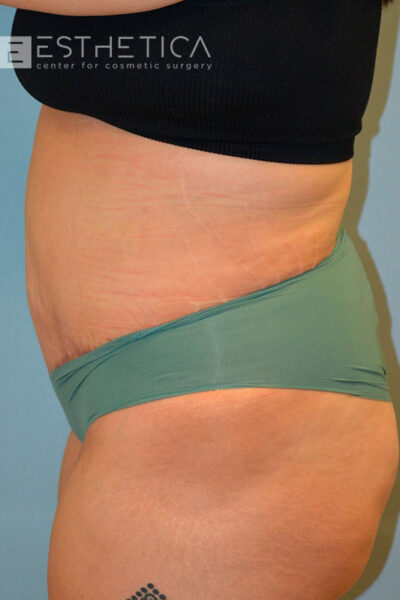 27yo__FemaleLiposuction-of-the-abdomen,-flanks,-and-abdominoplasty-with-muscle-plication__after-3