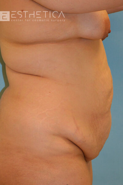 27yo__FemaleLiposuction-of-the-abdomen,-flanks,-and-abdominoplasty-with-muscle-plication__before-1