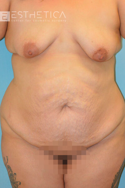 27yo__FemaleLiposuction-of-the-abdomen,-flanks,-and-abdominoplasty-with-muscle-plication__before-2