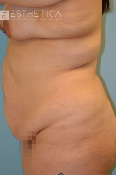 27yo__FemaleLiposuction-of-the-abdomen,-flanks,-and-abdominoplasty-with-muscle-plication__before-3
