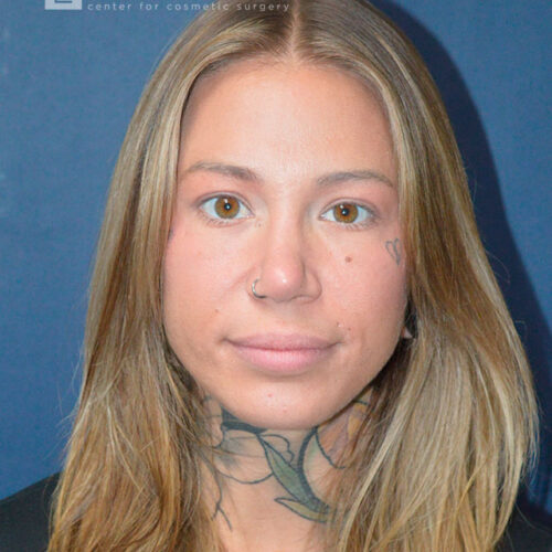 32yo__Female-Rhinoplasty__after-1