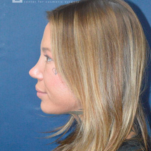 32yo__Female-Rhinoplasty__after-2