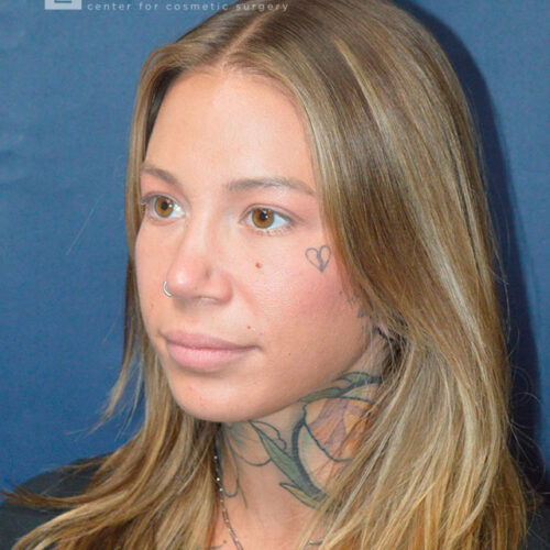 32yo__Female-Rhinoplasty__after-3