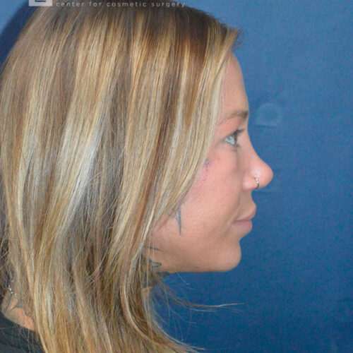 32yo__Female-Rhinoplasty__after-4
