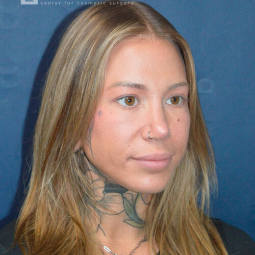 32yo__Female-Rhinoplasty__after-5