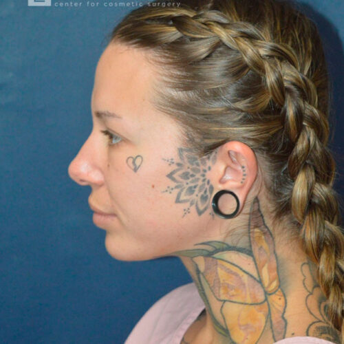 32yo__Female-Rhinoplasty__before-2