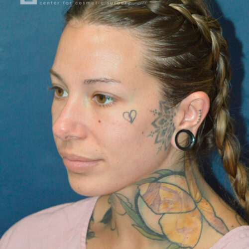 32yo__Female-Rhinoplasty__before-3