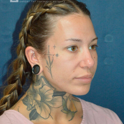 32yo__Female-Rhinoplasty__before-5