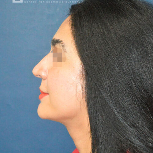 51yo__Female-Mini-Facelift,-Liposuction-of-the-chin-and-neck__after-1