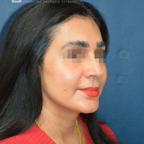 51yo__Female-Mini-Facelift,-Liposuction-of-the-chin-and-neck__after-2