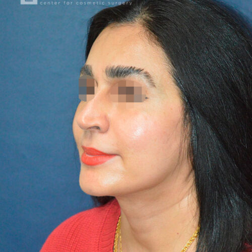 51yo__Female-Mini-Facelift,-Liposuction-of-the-chin-and-neck__after-3