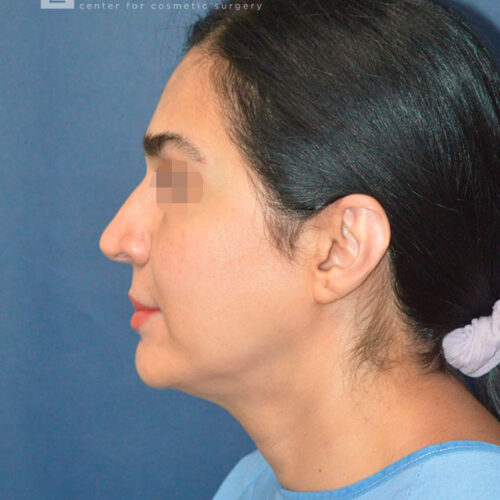 51yo__Female-Mini-Facelift,-Liposuction-of-the-chin-and-neck__before-1