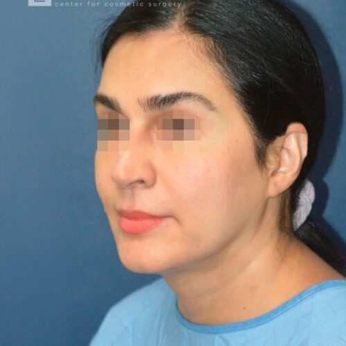 51yo__Female-Mini-Facelift,-Liposuction-of-the-chin-and-neck__before-3