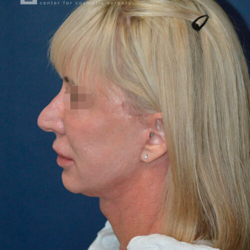 54yo__Female,--Lower-facelift,-upper-bleph-and-natural-fat-transfer-to-the-face-and-hands__after-2