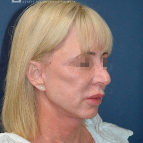54yo__Female,--Lower-facelift,-upper-bleph-and-natural-fat-transfer-to-the-face-and-hands__after-3
