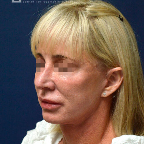 54yo__Female,--Lower-facelift,-upper-bleph-and-natural-fat-transfer-to-the-face-and-hands__after-4