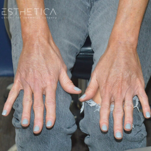 54yo__Female,--Lower-facelift,-upper-bleph-and-natural-fat-transfer-to-the-face-and-hands__after-5
