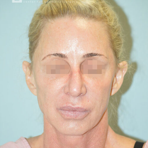 54yo__Female,--Lower-facelift,-upper-bleph-and-natural-fat-transfer-to-the-face-and-hands__before-1