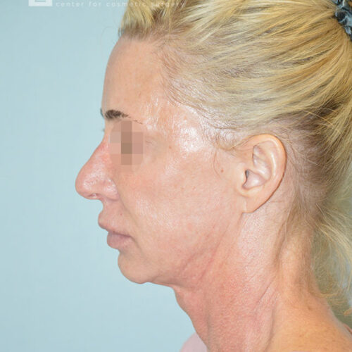 54yo__Female,--Lower-facelift,-upper-bleph-and-natural-fat-transfer-to-the-face-and-hands__before-2