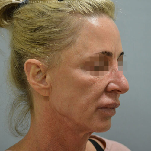 54yo__Female,--Lower-facelift,-upper-bleph-and-natural-fat-transfer-to-the-face-and-hands__before-3