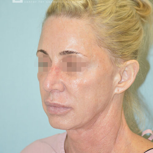 54yo__Female,--Lower-facelift,-upper-bleph-and-natural-fat-transfer-to-the-face-and-hands__before-4