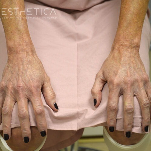 54yo__Female,--Lower-facelift,-upper-bleph-and-natural-fat-transfer-to-the-face-and-hands__before-5