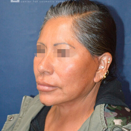60yo__Female-Complete-Lower-facelift__after-1