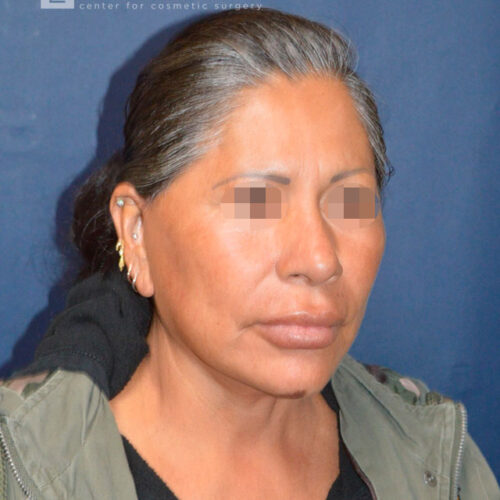 60yo__Female-Complete-Lower-facelift__after-2