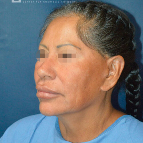 60yo__Female-Complete-Lower-facelift__before-1